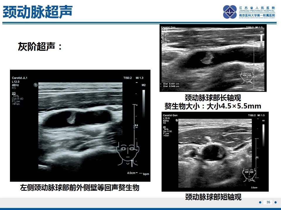 影像PPT - 【PPT】颈动脉蹼-37