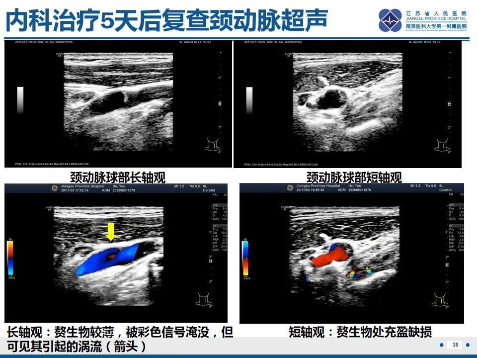 影像PPT - 【PPT】颈动脉蹼-40