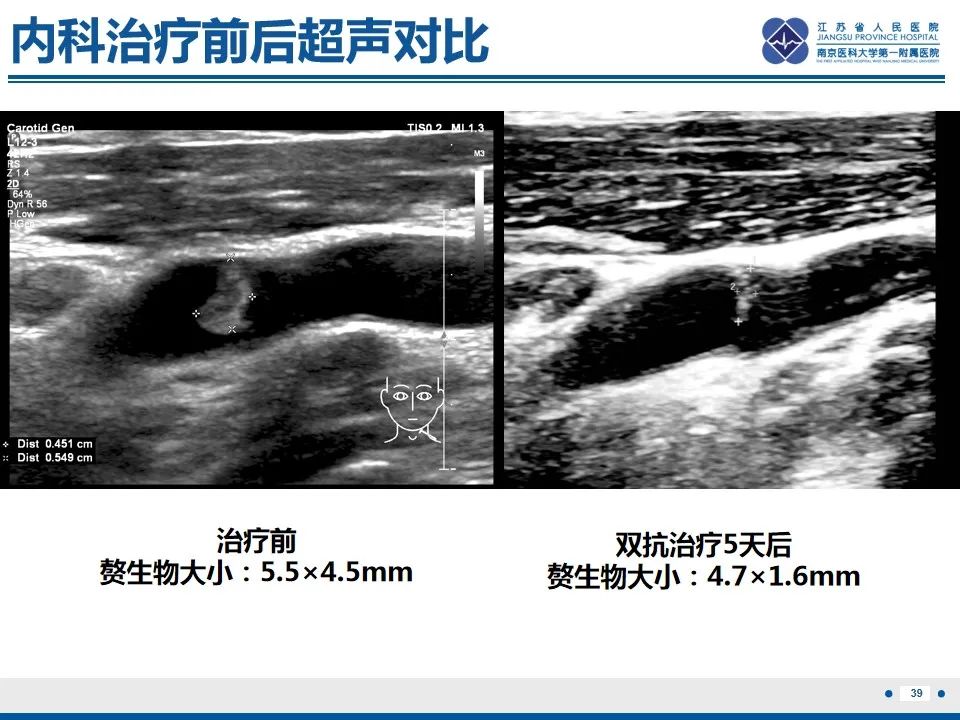 影像PPT - 【PPT】颈动脉蹼-41