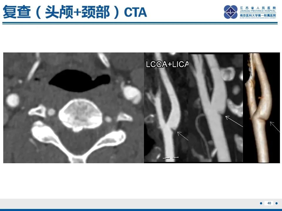 影像PPT - 【PPT】颈动脉蹼-42