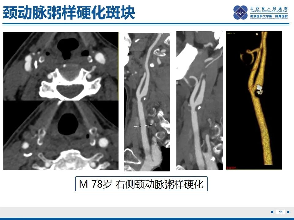 影像PPT - 【PPT】颈动脉蹼-46