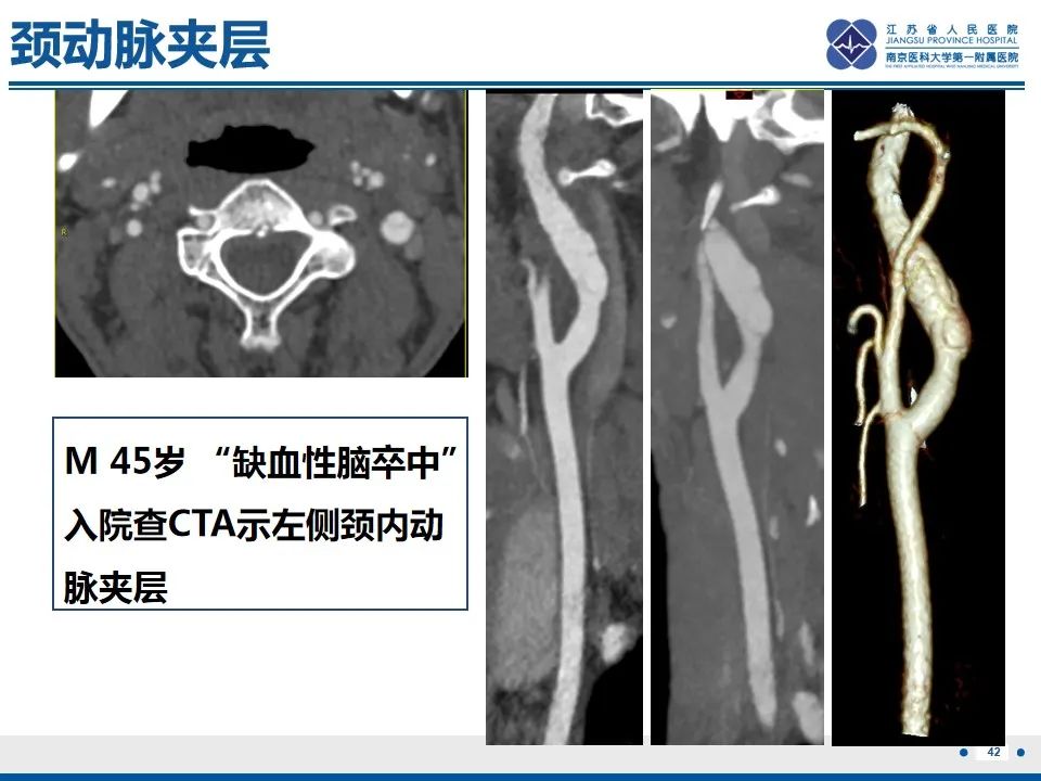 影像PPT - 【PPT】颈动脉蹼-44