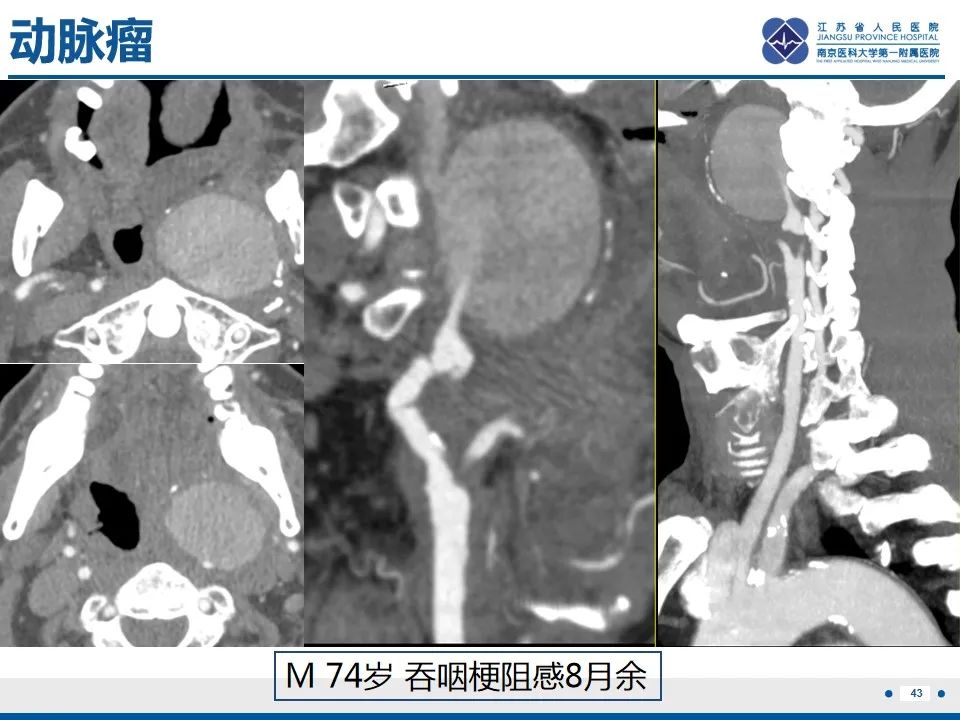 影像PPT - 【PPT】颈动脉蹼-45