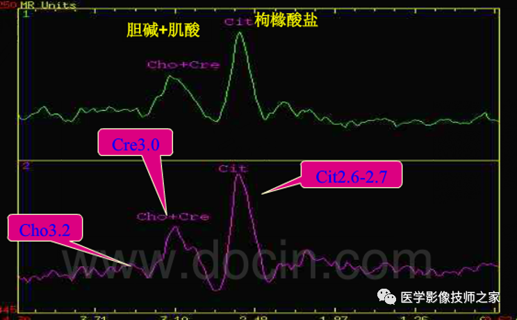 影像PPT - 磁共振波普(MRS)检查-24 影像PPT - 磁共振波普(MRS)检查-24