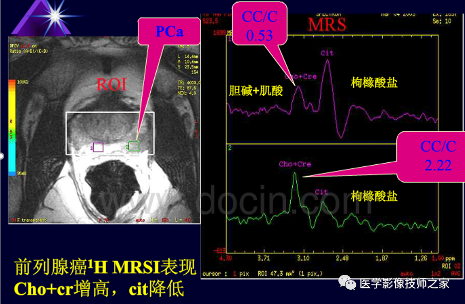 影像PPT - 磁共振波普(MRS)检查-25 影像PPT - 磁共振波普(MRS)检查-25