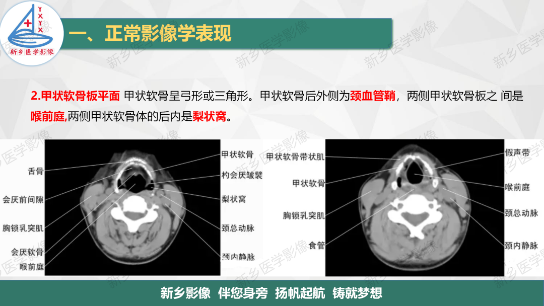 影像PPT - 【PPT】医学影像诊断学教材解读—颈部疾病2-5