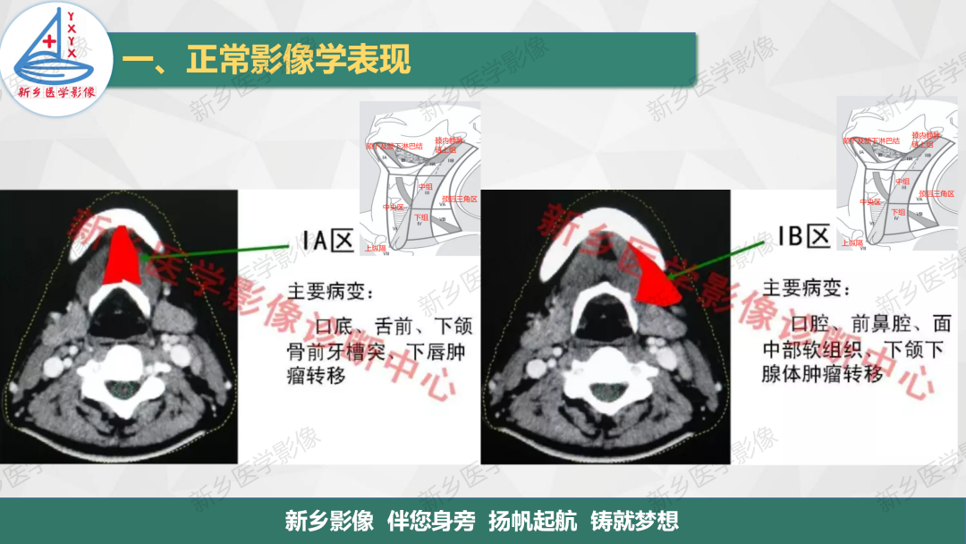 影像PPT - 【PPT】医学影像诊断学教材解读—颈部疾病2-10