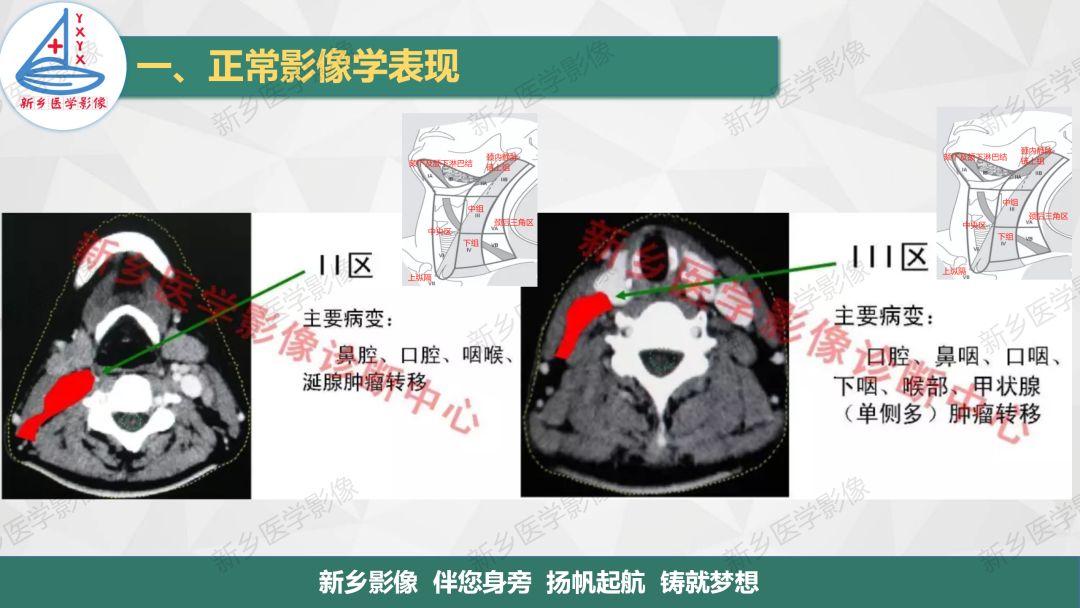 影像PPT - 【PPT】医学影像诊断学教材解读—颈部疾病2-11