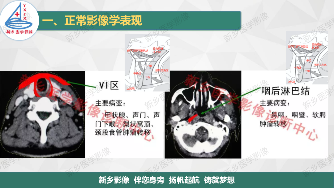 影像PPT - 【PPT】医学影像诊断学教材解读—颈部疾病2-13