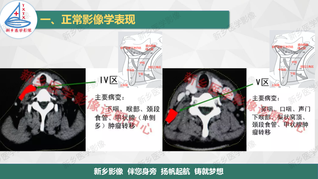 影像PPT - 【PPT】医学影像诊断学教材解读—颈部疾病2-12