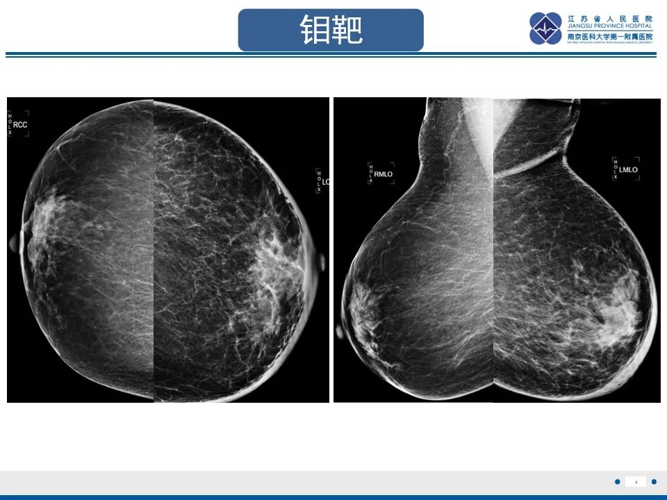 影像PPT - 【PPT】乳腺转移瘤-4