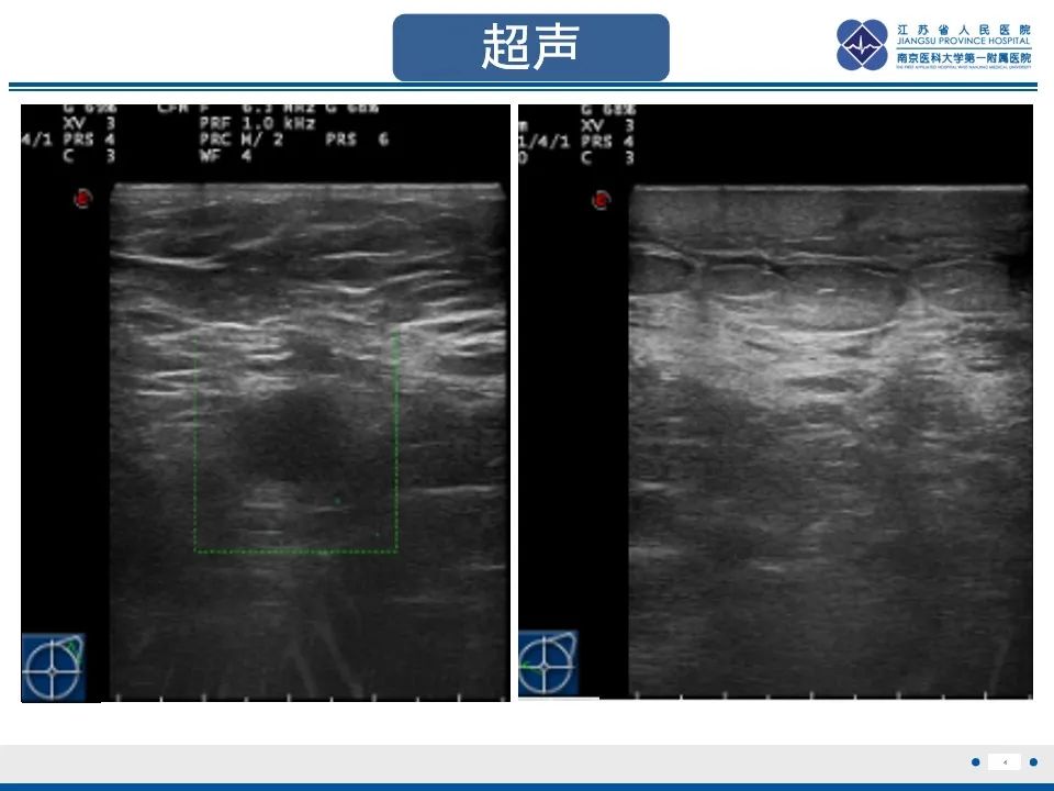影像PPT - 【PPT】乳腺转移瘤-5