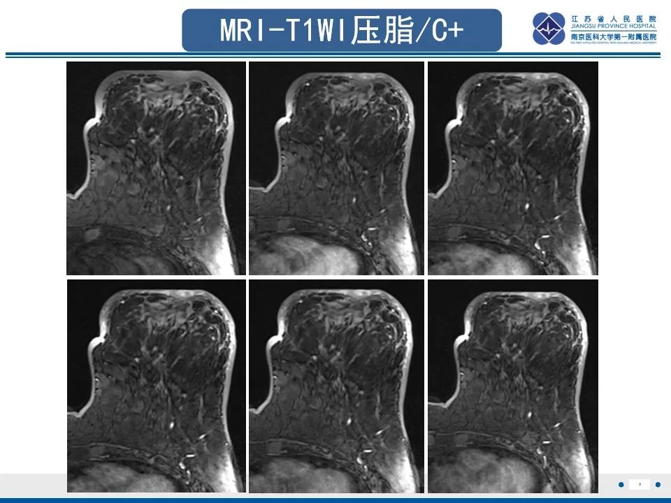 影像PPT - 【PPT】乳腺转移瘤-8
