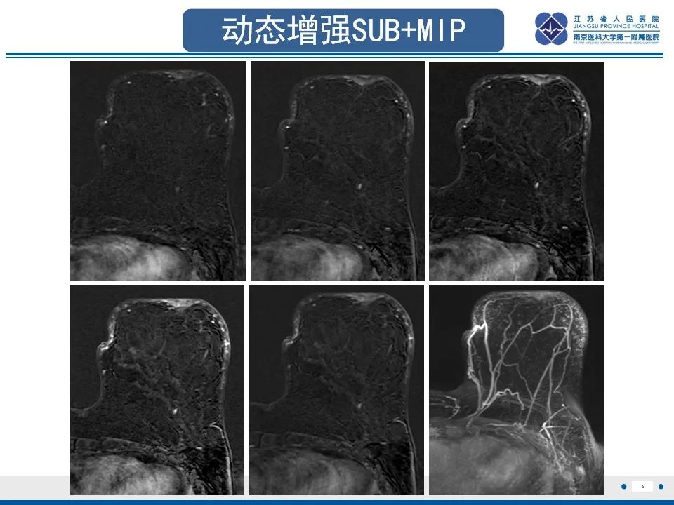影像PPT - 【PPT】乳腺转移瘤-9