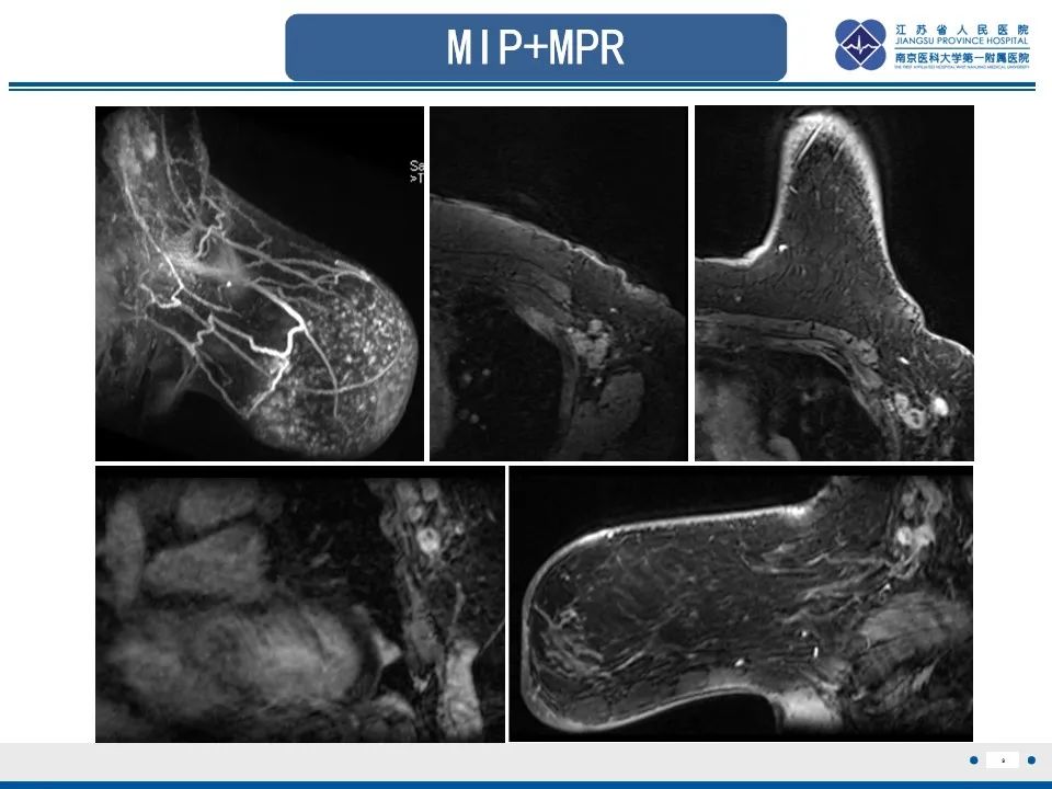 影像PPT - 【PPT】乳腺转移瘤-10