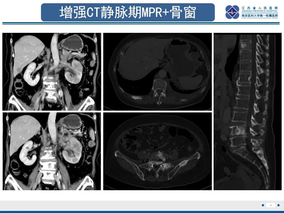 影像PPT - 【PPT】乳腺转移瘤-12