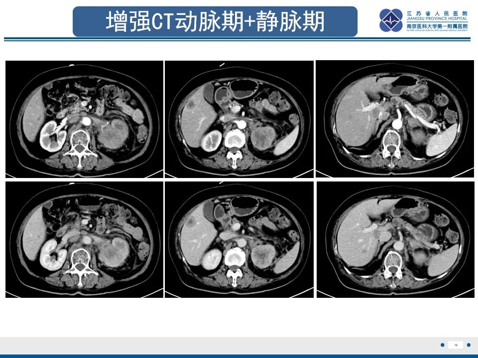 影像PPT - 【PPT】乳腺转移瘤-11