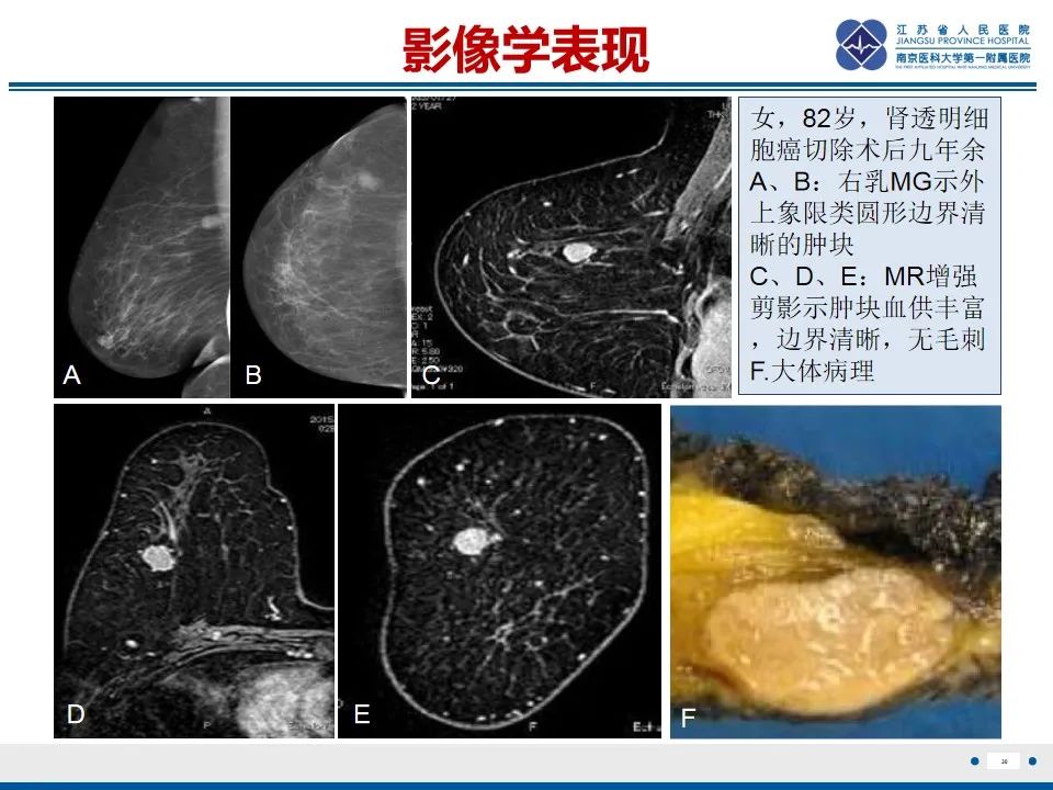 影像PPT - 【PPT】乳腺转移瘤-31