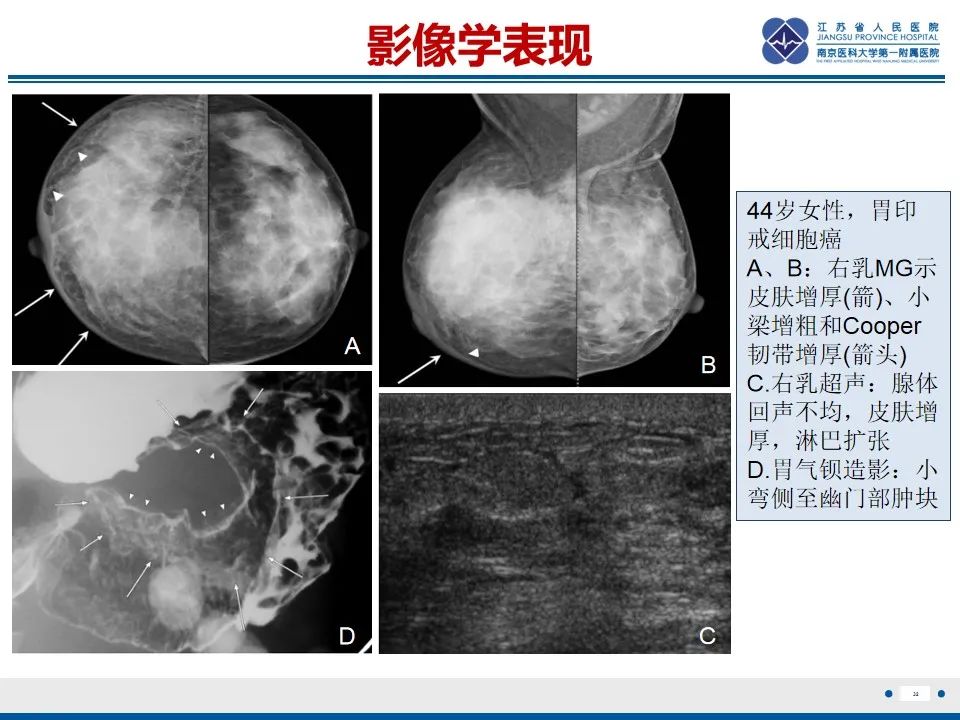 影像PPT - 【PPT】乳腺转移瘤-33