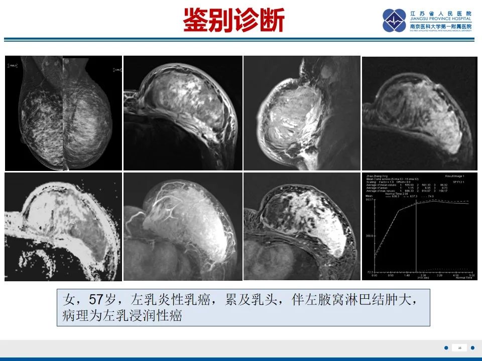 影像PPT - 【PPT】乳腺转移瘤-36