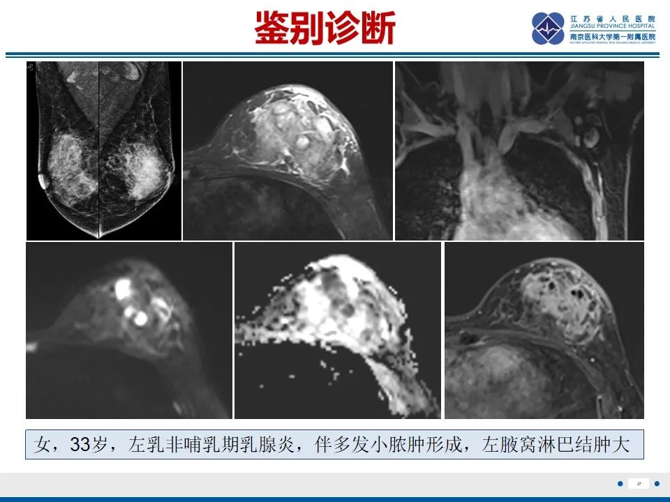 影像PPT - 【PPT】乳腺转移瘤-38