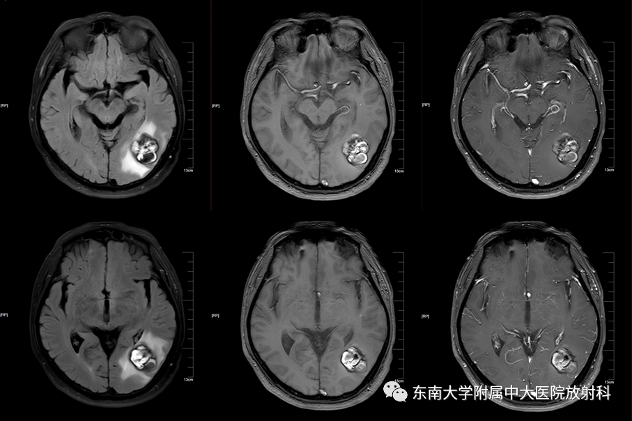 影像PPT - 【PPT】颅内海绵状血管瘤-1