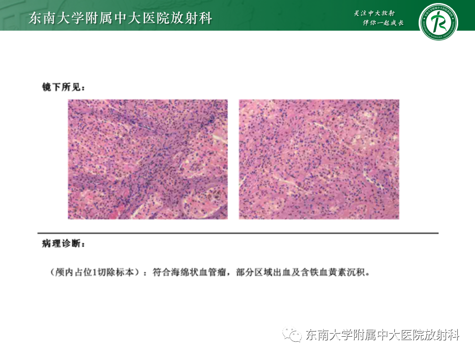 影像PPT - 【PPT】颅内海绵状血管瘤-3