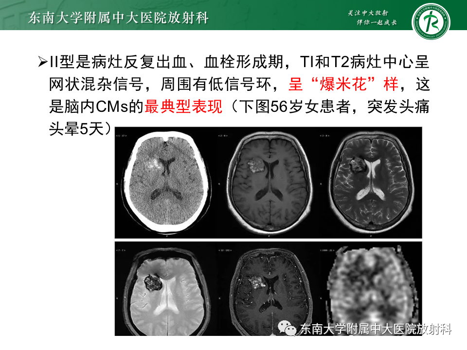 影像PPT - 【PPT】颅内海绵状血管瘤-12