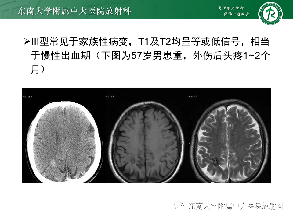 影像PPT - 【PPT】颅内海绵状血管瘤-13