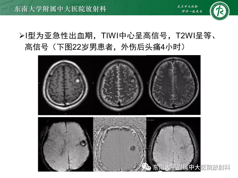 影像PPT - 【PPT】颅内海绵状血管瘤-11