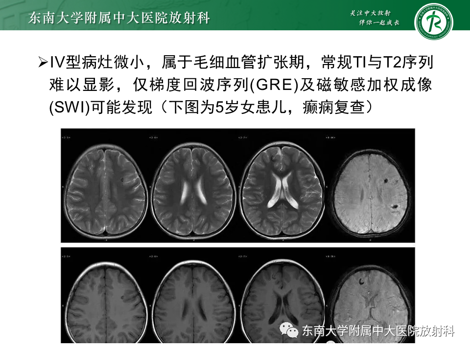 影像PPT - 【PPT】颅内海绵状血管瘤-14