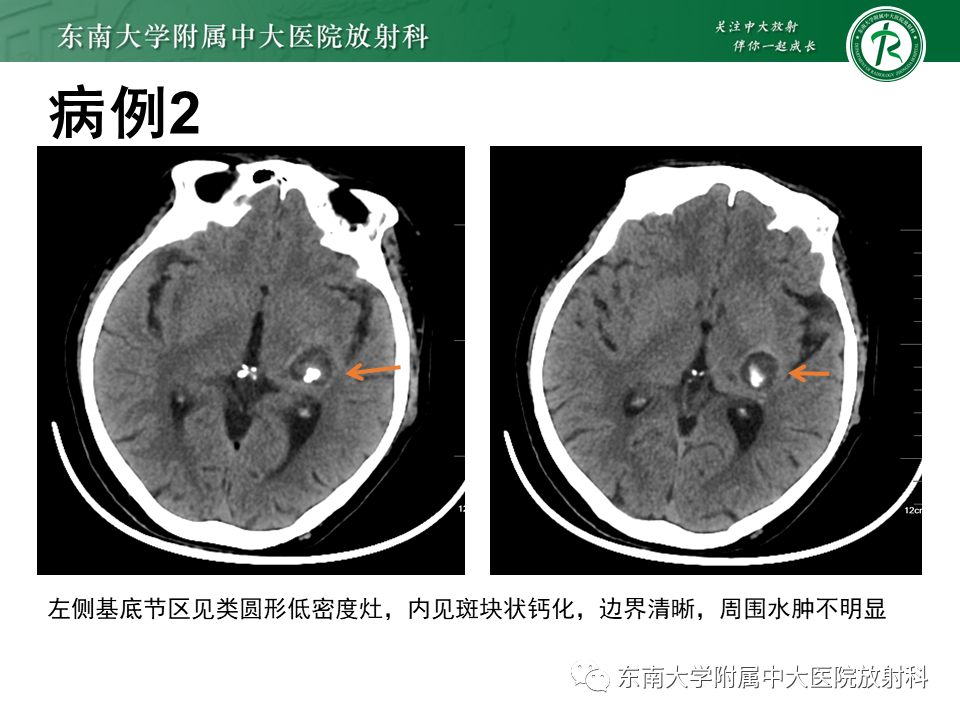 影像PPT - 【PPT】颅内海绵状血管瘤-16