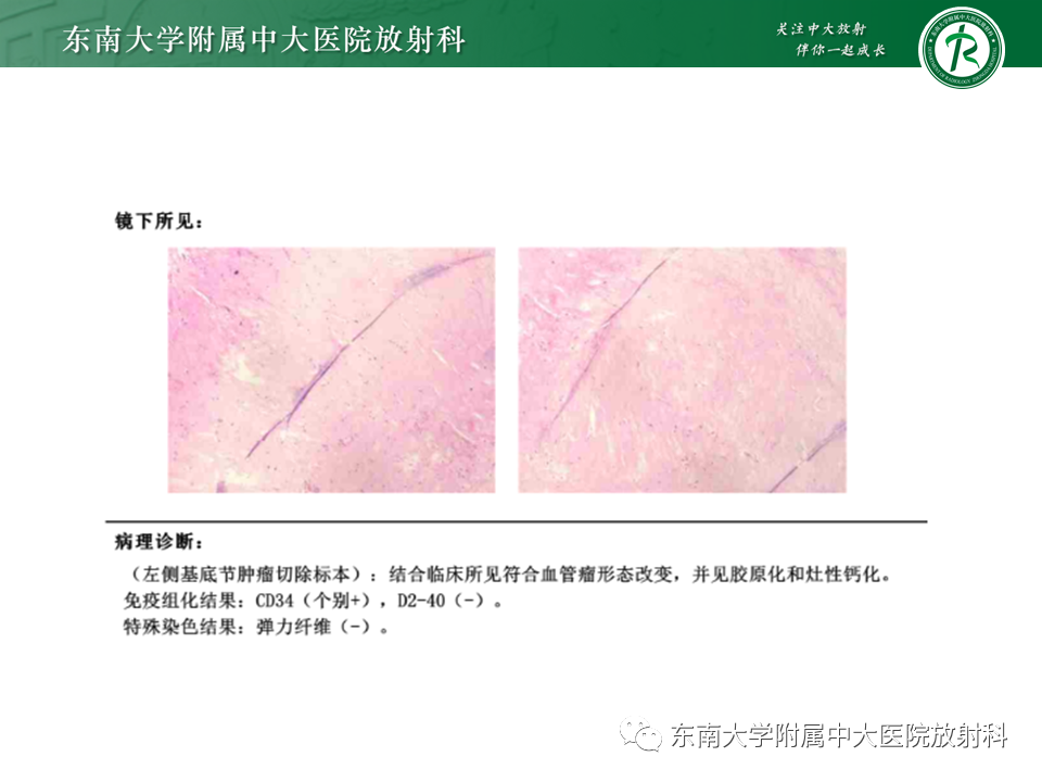影像PPT - 【PPT】颅内海绵状血管瘤-18