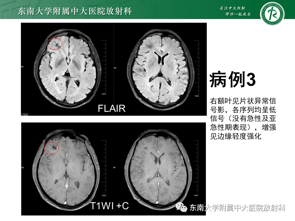 影像PPT - 【PPT】颅内海绵状血管瘤-19