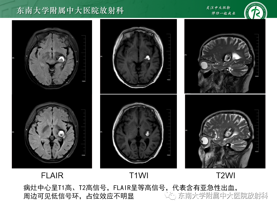 影像PPT - 【PPT】颅内海绵状血管瘤-17