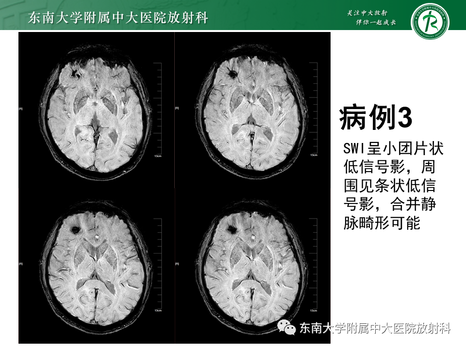 影像PPT - 【PPT】颅内海绵状血管瘤-20
