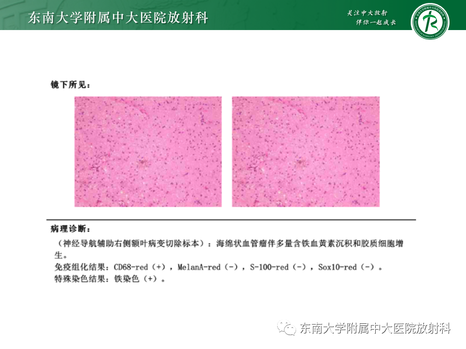 影像PPT - 【PPT】颅内海绵状血管瘤-21