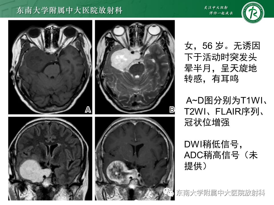 影像PPT - 【PPT】颅内海绵状血管瘤-23
