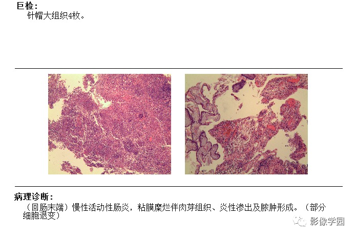 影像PPT - 【病例】肠克罗恩病1例CT及MR诊断思路与鉴别-5 影像PPT - 【病例】肠克罗恩病1例CT及MR诊断思路与鉴别-5