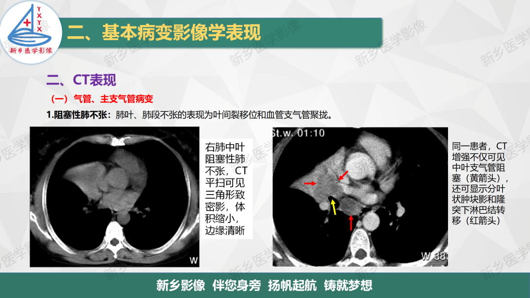 影像PPT - 【PPT】医学影像诊断学教材解读—胸部CT基本病变影像表现-2