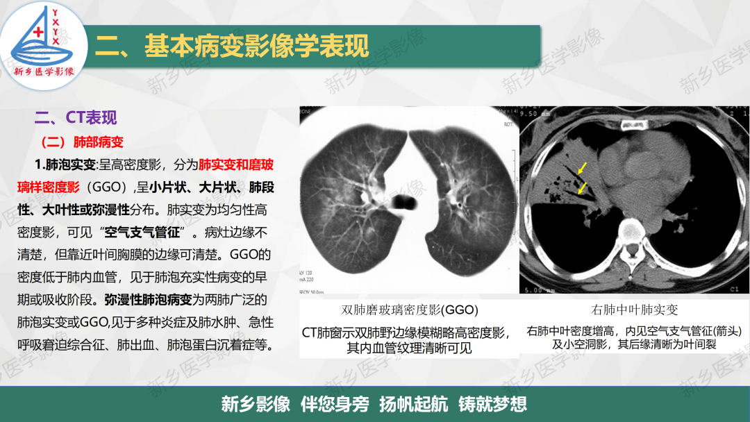 影像PPT - 【PPT】医学影像诊断学教材解读—胸部CT基本病变影像表现-5