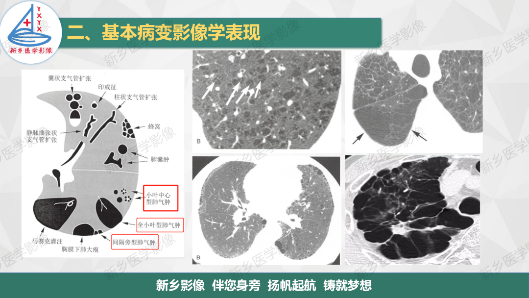 影像PPT - 【PPT】医学影像诊断学教材解读—胸部CT基本病变影像表现-4