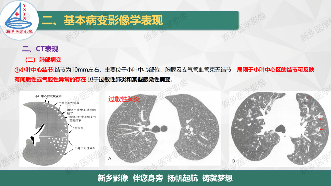 影像PPT - 【PPT】医学影像诊断学教材解读—胸部CT基本病变影像表现-12