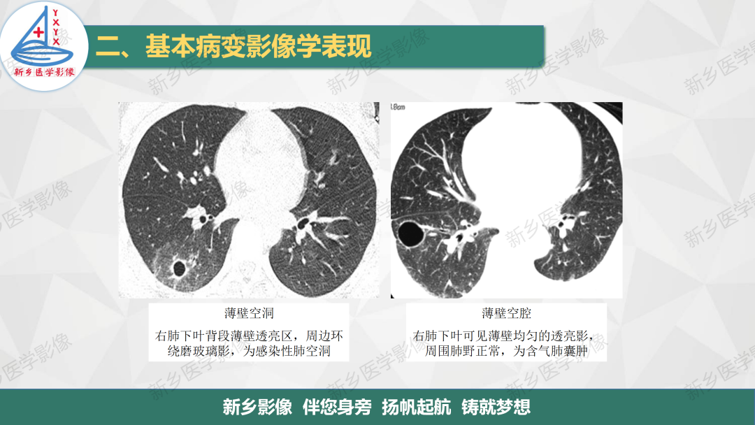 影像PPT - 【PPT】医学影像诊断学教材解读—胸部CT基本病变影像表现-15