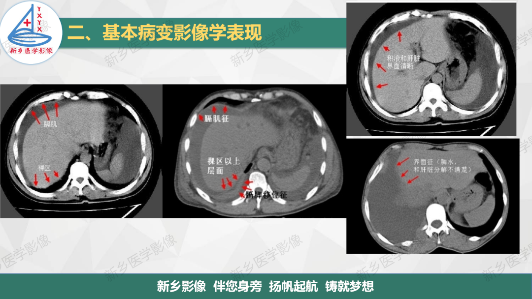 影像PPT - 【PPT】医学影像诊断学教材解读—胸部CT基本病变影像表现-19