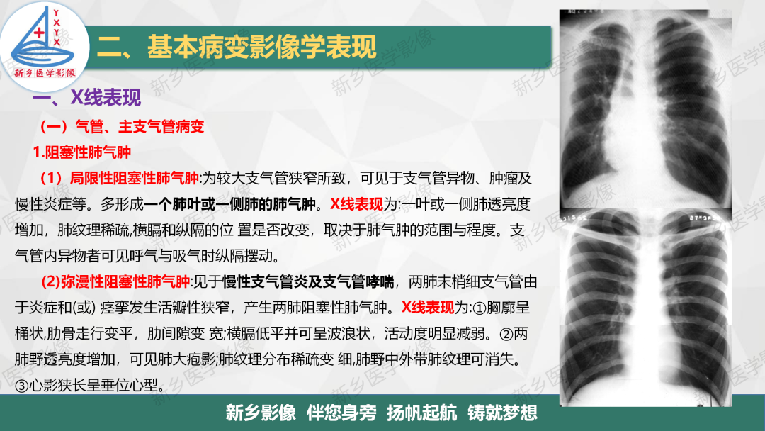 影像PPT - 【PPT】医学影像诊断学教材解读—胸部CT基本病变影像表现1-4