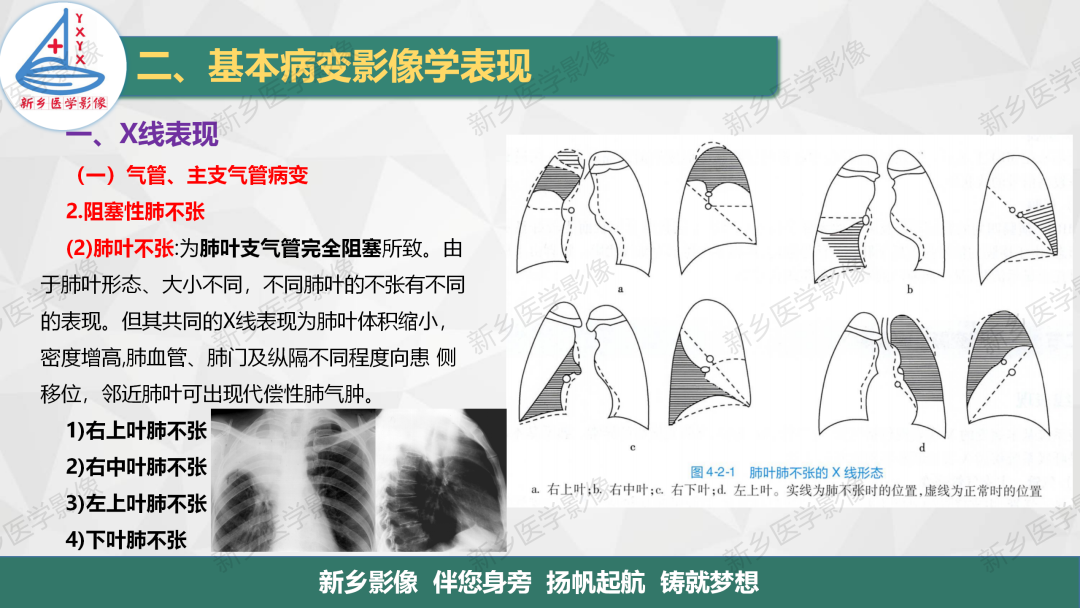 影像PPT - 【PPT】医学影像诊断学教材解读—胸部CT基本病变影像表现1-6