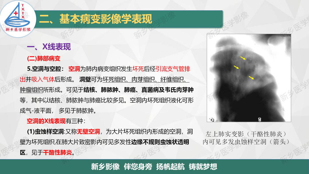 影像PPT - 【PPT】医学影像诊断学教材解读—胸部CT基本病变影像表现1-12