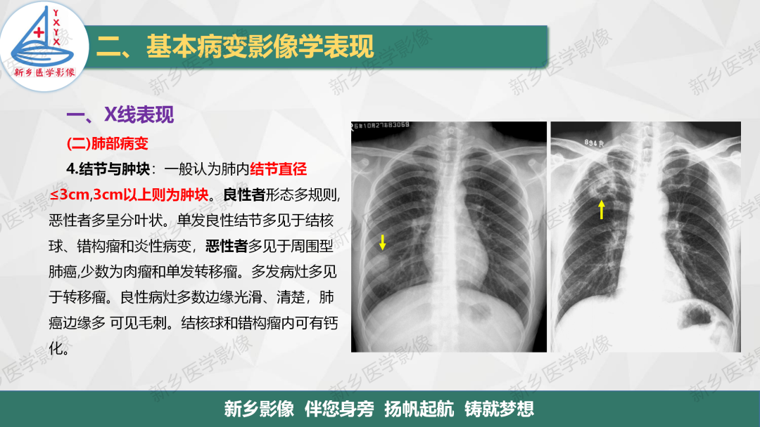 影像PPT - 【PPT】医学影像诊断学教材解读—胸部CT基本病变影像表现1-11