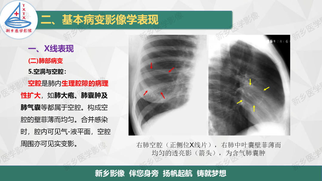 影像PPT - 【PPT】医学影像诊断学教材解读—胸部CT基本病变影像表现1-15